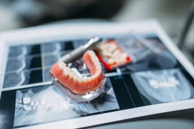 Odontologė paneigė tris didžiausius mitus apie dantų protezavimą