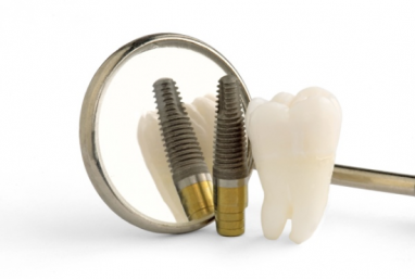 Dantų implantacija - sparčiausiai besivystanti odontologijos šaka