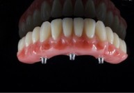 Unikalus išradimas – viso žandikaulio dantys per vieną dieną – pateisina lūkesčius