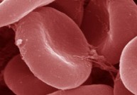 Užslėpta anemija – lyg uždelsto veikimo bomba