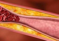 Cholesterolio kontrolė sumažina mirtingumą