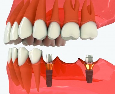 Šiuolaikinė dantų implantacija