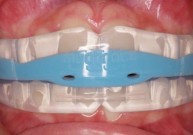 Apie ortodontinio gydymo breketų sistema alternatyvas
