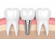 Kodėl sunku rasti tikslią dantų implantacijos kainą?