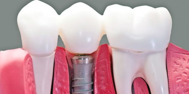 Dantų implantai Šiauliuose: kokią kliniką pasirinkti?