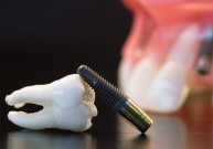 Dantų implantai – ne tik dėl grožio