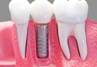 Pažangiausias gydymo metodas odontologijoje - dantų implantacija!