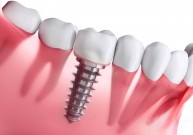 Kokie dantų implantai perkamiausi?