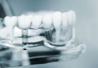 Dantų protezavimas: kokią galimybę pasirinkti?