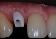 Patvarūs ir ilgaamžiai dantų implantai – sprendimas praradus dantis