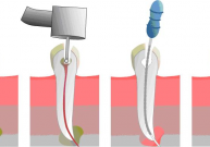 Endodontijoje naudojamo mikroskopo nauda pacientui ir privalumai gyd. endodontui