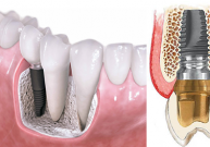 Dantų implantavimasVilniuje