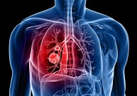 Plaučių vėžio simptomai ir stadijos