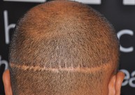 Nuplikimo korekcijos: plaukų persodinimas ir kitos operacijos