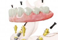 Dantų implantų metodika "All on 4": kokie jos privalumai?