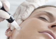 Mikroadatinės procedūros – kolageno „sukūrimo“ terapija odos estetinėms problemoms spręsti