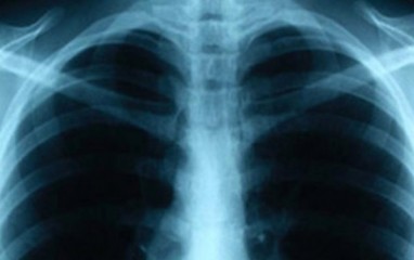 Kitų organų tuberkuliozė | joomla123.lt