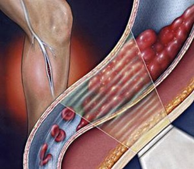 Giliųjų venų trombozė (GVT) – susirgimas, kuris gali baigtis paciento mirtimi