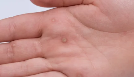 Stebėtinai daugialypis žmogaus papilomos virusas