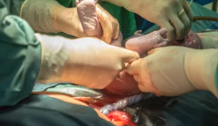 Vengrijoje – aistros dėl dažno cezario pjūvio taikymo gimdyvėms