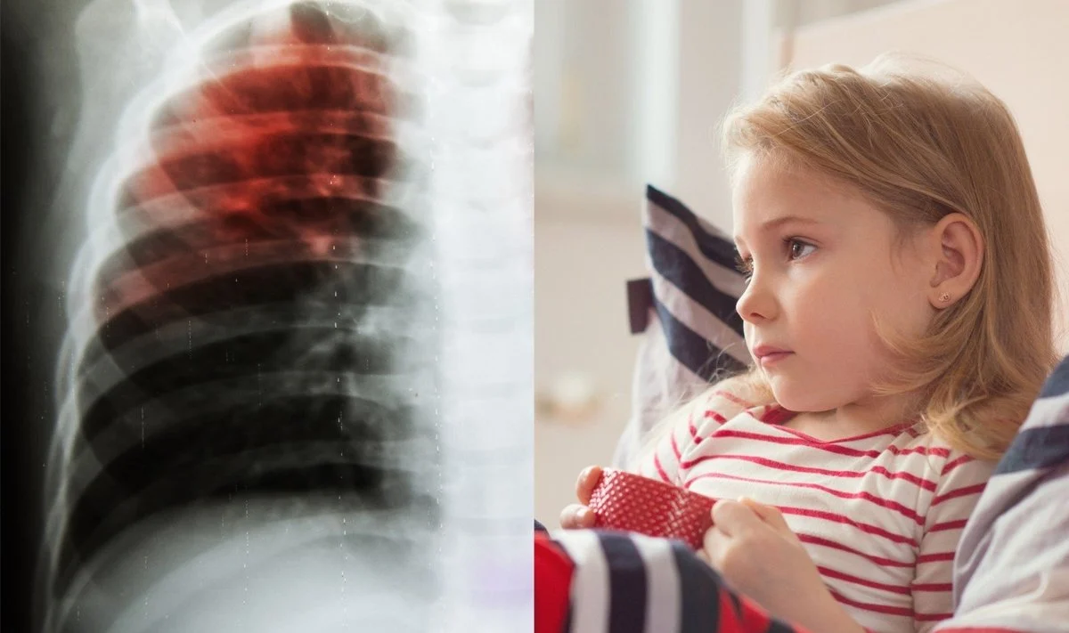 Naujas prietaisas palengvins tuberkulioze sergančių vaikų gydymą