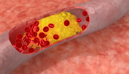 Kaip sumažinti cholesterolio kiekį?