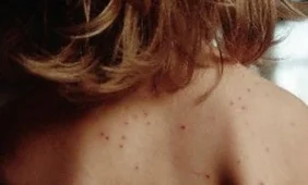 Patvirtinta nauja tymų ir raudonukės kontrolės tvarka