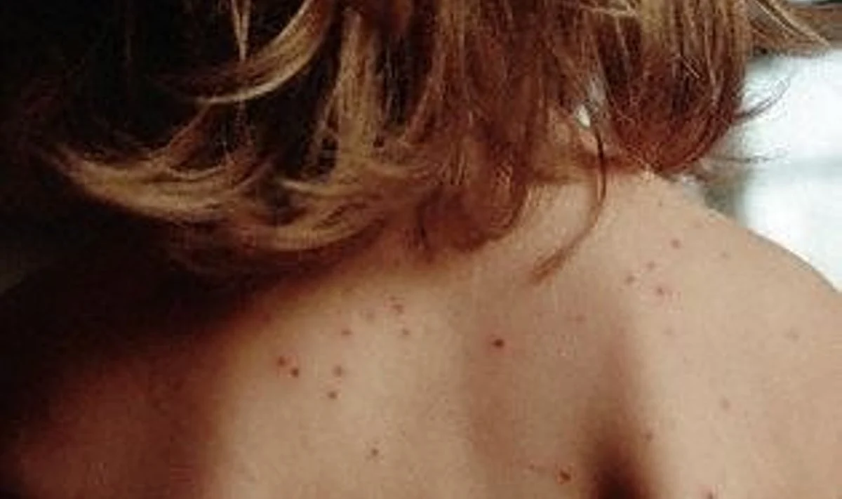 Patvirtinta nauja tymų ir raudonukės kontrolės tvarka