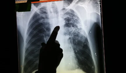 Panevėžyje – aistros dėl sergančiųjų tuberkulioze gydymo vietos
