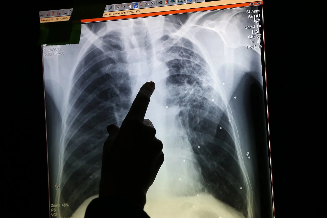 Panevėžyje – aistros dėl sergančiųjų tuberkulioze gydymo vietos