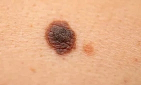 Antioksidantai melanomos neskatina