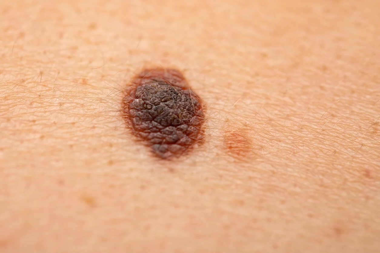 Antioksidantai melanomos neskatina