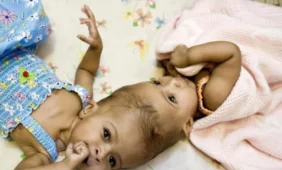 Medikai atskyrė galvomis suaugusias Siamo dvynes