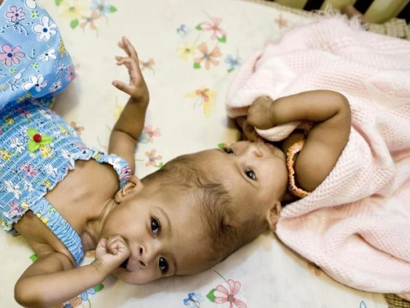 Medikai atskyrė galvomis suaugusias Siamo dvynes