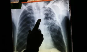 Dėl krizės gali padaugėti tuberkuliozės atvejų