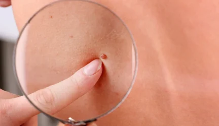 Tėvai raginami atkreipti dėmesį į vaikų apgamus