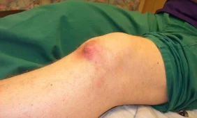 Lietuvoje pirmą kartą persodintas meniskas