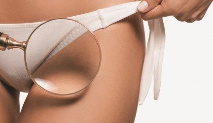 bikini zonos depiliacija