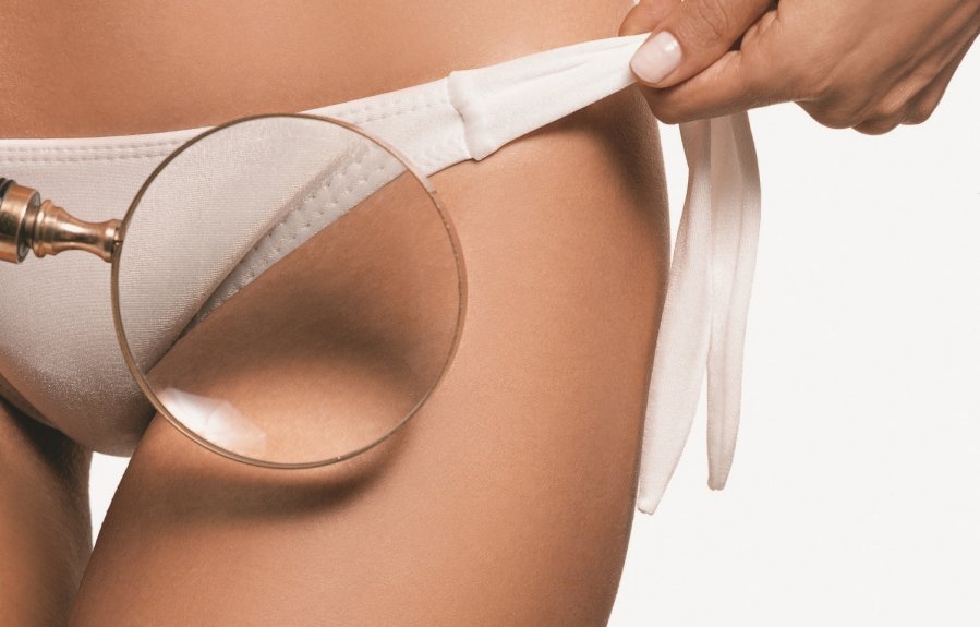 bikini zonos depiliacija