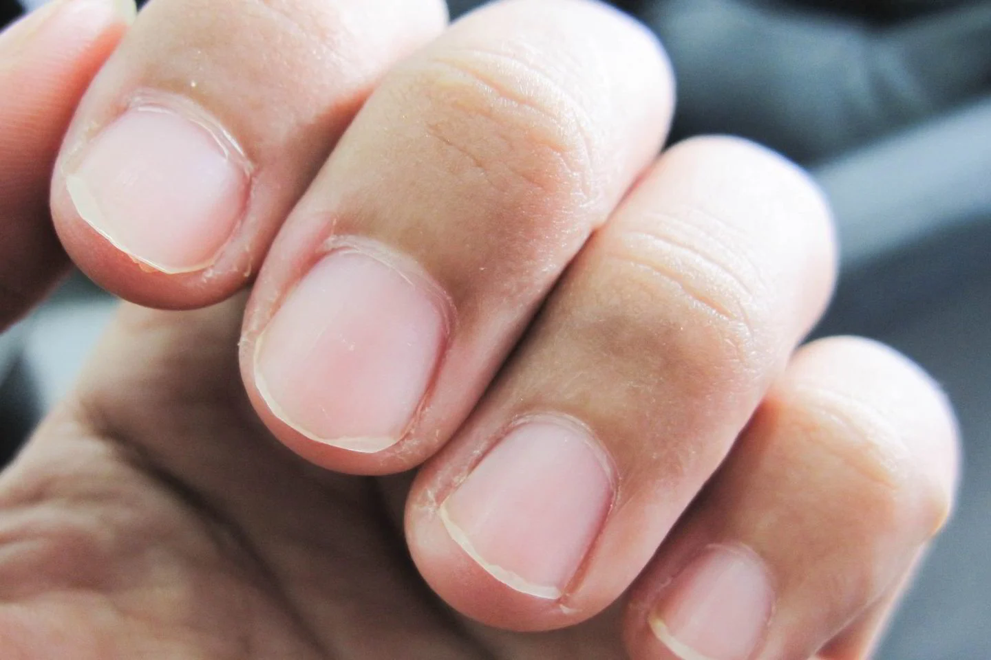 Prieš vėžį kovojama ir varlėmis