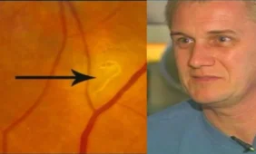 Medikai vyrui iš akies pašalino kirminą