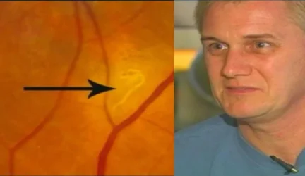 Medikai vyrui iš akies pašalino kirminą