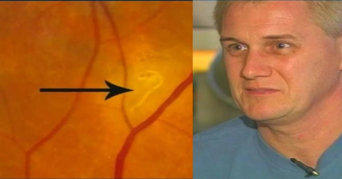 Medikai vyrui iš akies pašalino kirminą