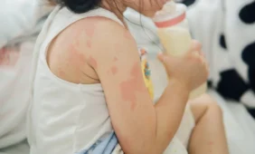 Alergijos