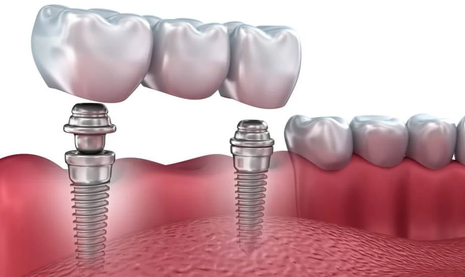 dantų implantacija