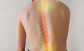 Kas yra skoliozė ir kas ją sukelia?