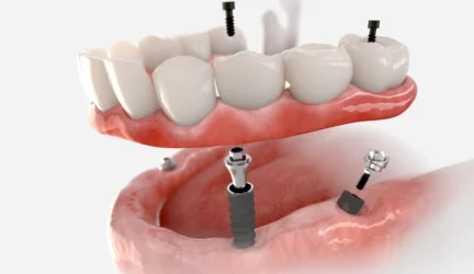 Dantų implantacija