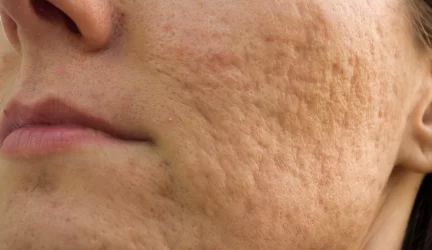 Procedūra nuo randų po spuogų Fusion Mesotherapy® adatinio volelio metodu