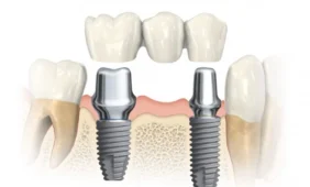Patvarūs ir ilgaamžiai dantų implantai – sprendimas praradus dantis