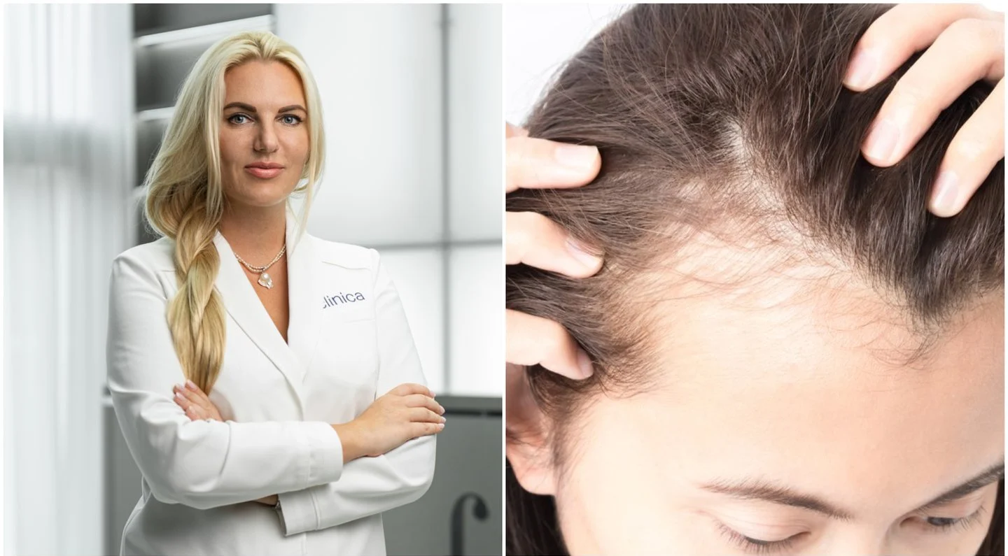 Alopecija